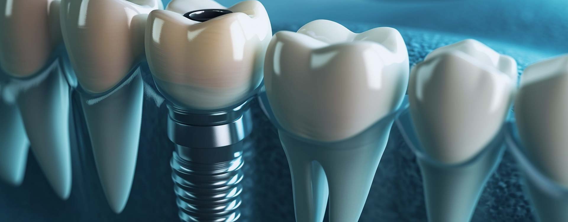 Коронки на имплантах